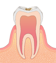 C1 歯のエナメル質内部まで溶けた状態